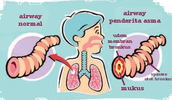 asma-animasi