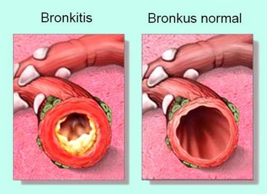 bronkitis