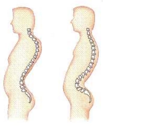 Gangguan tulang pada bagian tulang belakang melekuk selerti huruf s disebut