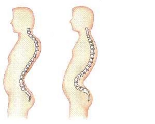 Pada penderita lordosis lekukan tulang belakangnya terlalu menjorok ke